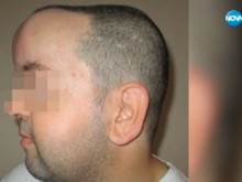 С уникална операция спасиха пациент с тумор в мозъка, тежащ над 1 кг