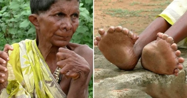 63-годишната индийка Кумар Айкак с необичайно количество пръсти, 31 на